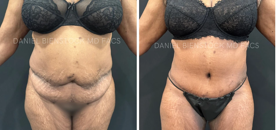 Before and after tummy tuck showing front torso contour results