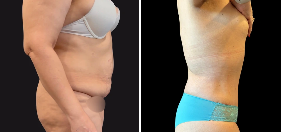 Before and after tummy tuck results showing side profile comparison of torso and waistline