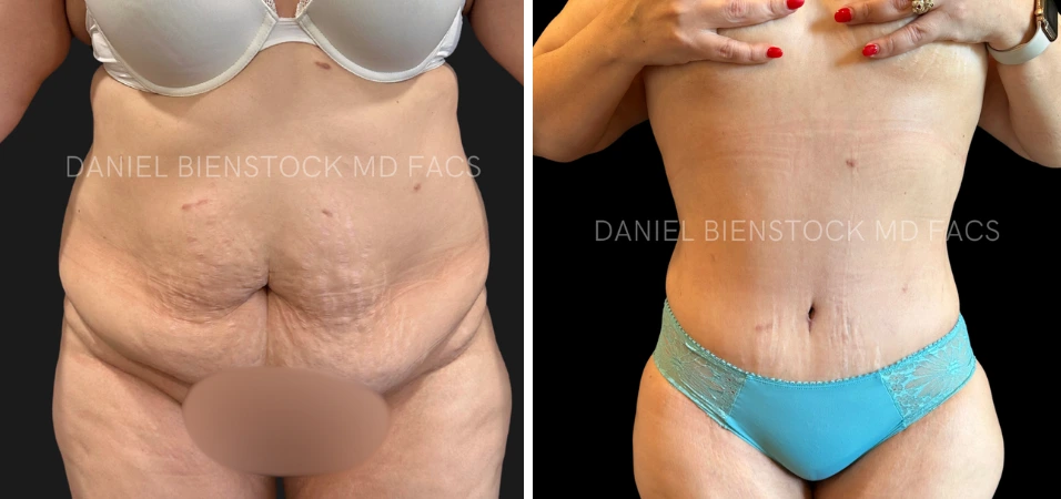 Before and after tummy tuck results showing rear view comparison of abdomen and lower body