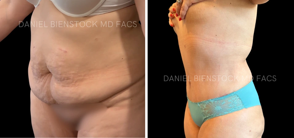 Before and after tummy tuck results showing side profile comparison of abdominal definition