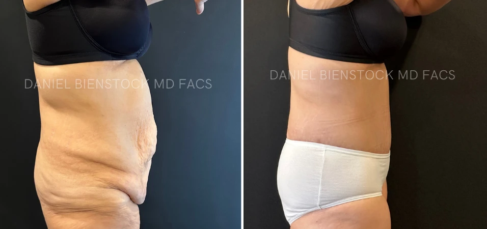 Before and after tummy tuck: loose abdominal skin on left, flatter contoured abdomen on right