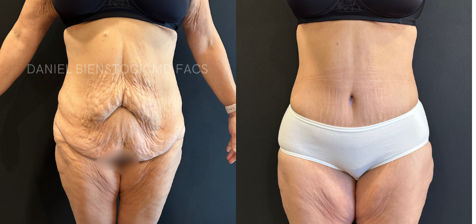Tummy Tuck-8-2