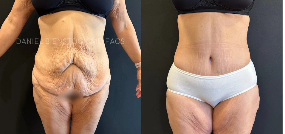Before and after tummy tuck results showing rear view comparison of abdomen and flanks