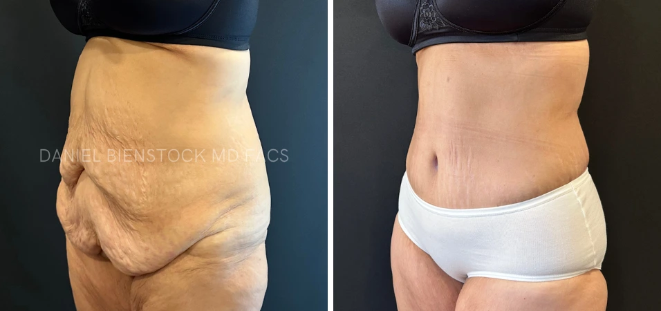 Before and after tummy tuck results showing side view comparison of abdominal contour