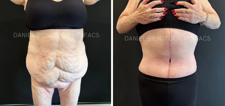 Before and after tummy tuck from front view demonstrating flattened abdomen and improved definition