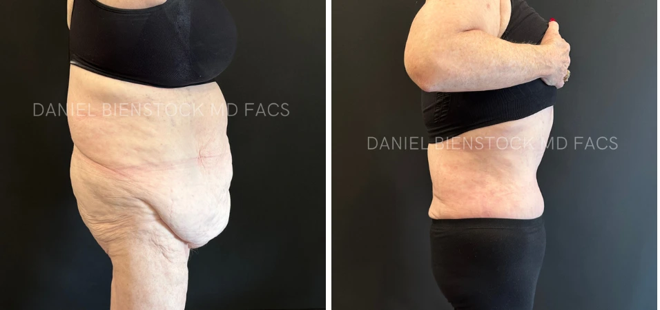 Before and after tummy tuck from side and front angles showing reduced abdominal laxity