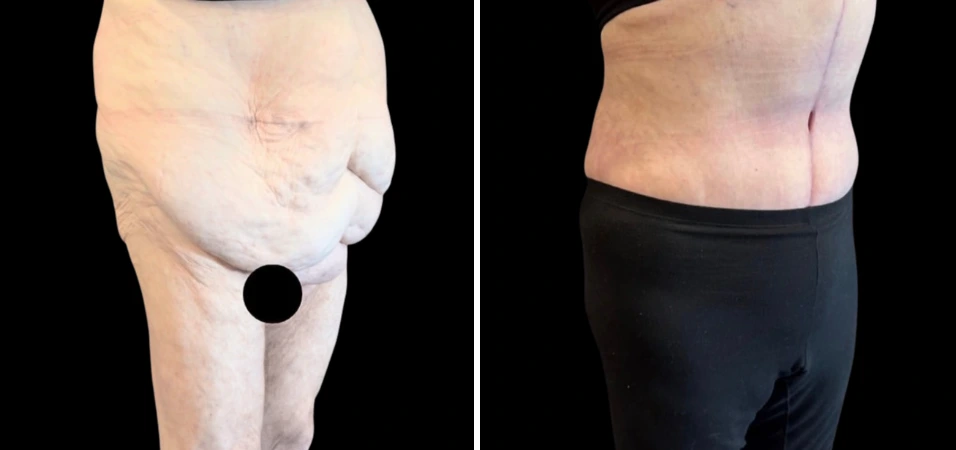 Before and after tummy tuck showing excess skin removal and improved abdominal contour