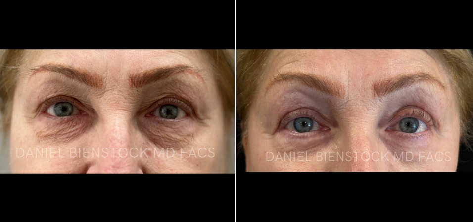 Before and after blepharoplasty, showing reduced upper eyelid fullness and improved eye opening