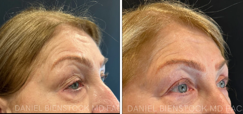 Before and after blepharoplasty in profile view, showing lifted upper eyelids and refreshed eye appearance
