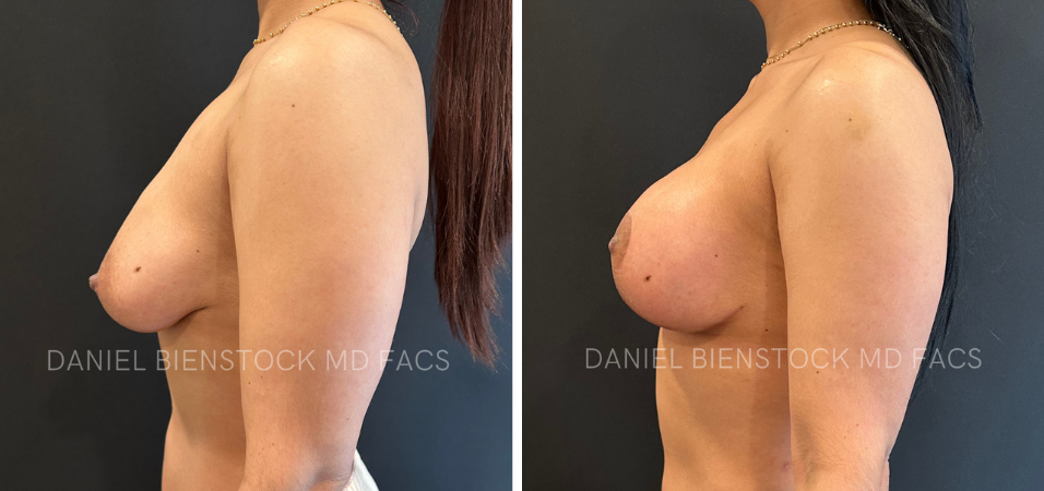 Buttocks Augmentation - 14-1