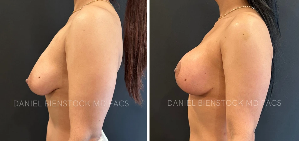 Before and after buttocks augmentation, side profile showing lifted and augmented contours