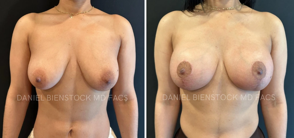 Before and after breast augmentation, frontal view showing enhanced size and shape