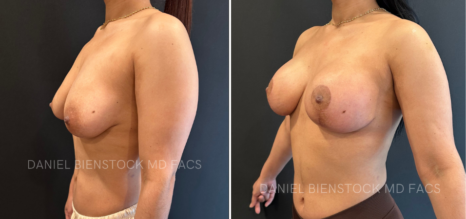 Buttocks Augmentation - 14-3
