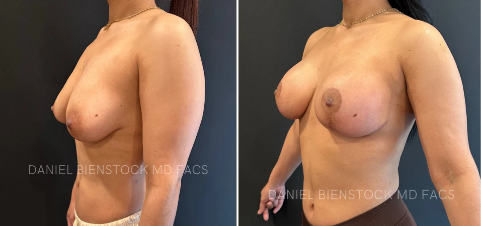 Before and after breast augmentation, side profile view showing improved contour