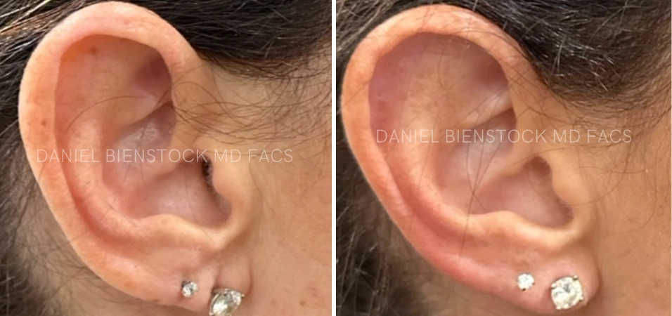 Before and after ear lobe repair, showing reduced lobe size and improved shape