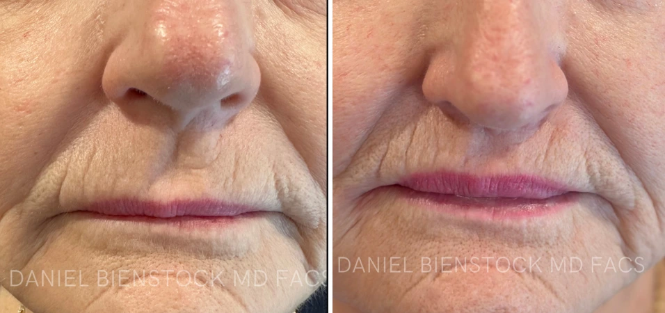 Before and after lip lift procedure, showing elevated lip position and improved upper lip definition