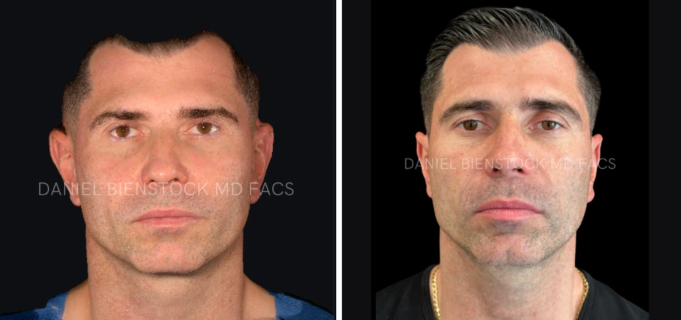 Before and after otoplasty, front-facing view showing repositioned ears closer to head