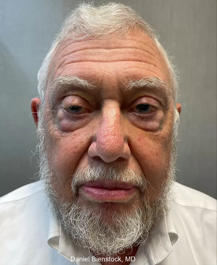 Before Blepharoplasty - Dr. Daniel Bienstock