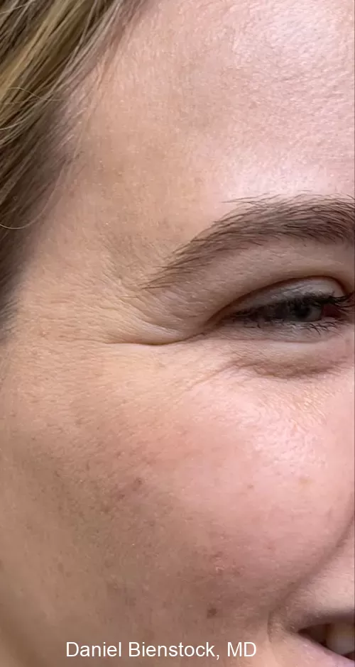 Before Botox - Dr. Daniel Bienstock