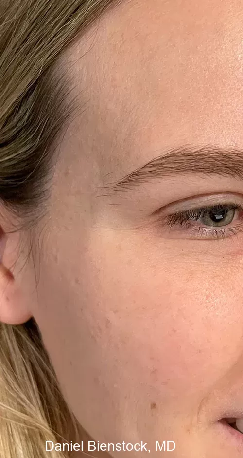 After Botox - Dr. Daniel Bienstock