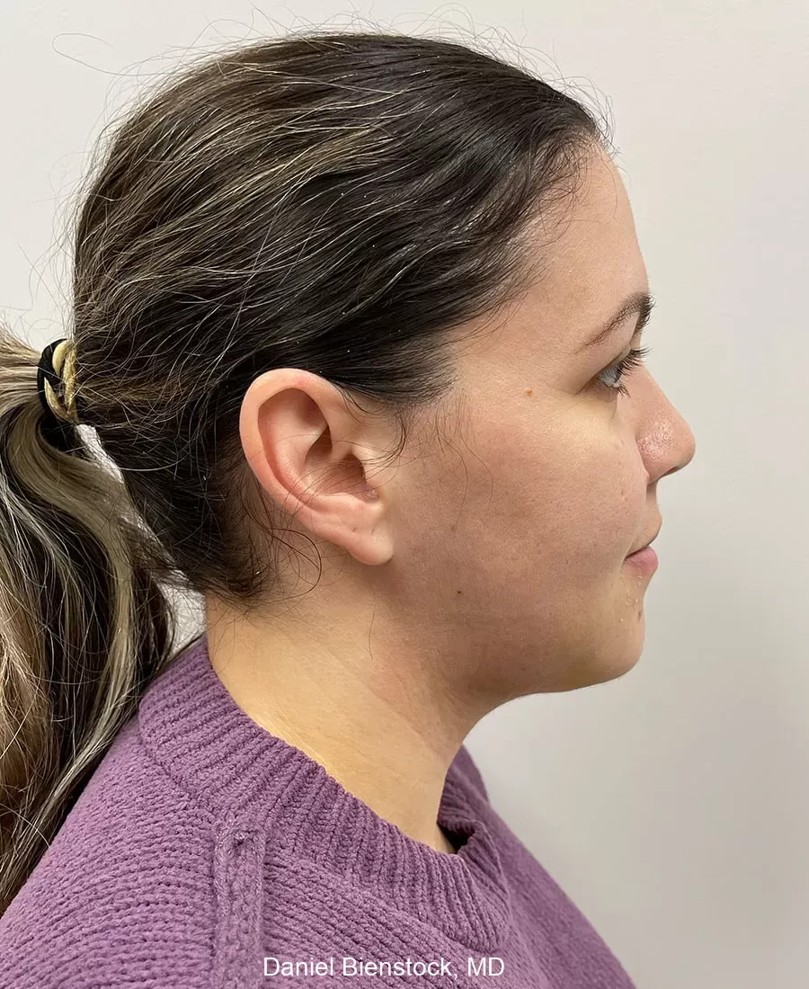 Before genioplasty - Dr. Daniel Bienstock