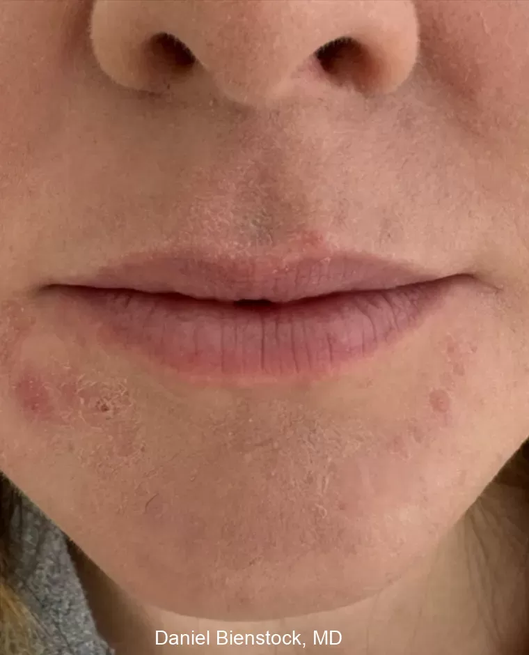 Before Lip Filler - Dr. Daniel Bienstock