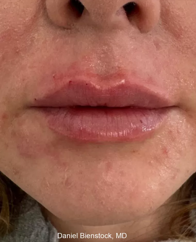 After Lip Filler - Dr. Daniel Bienstock