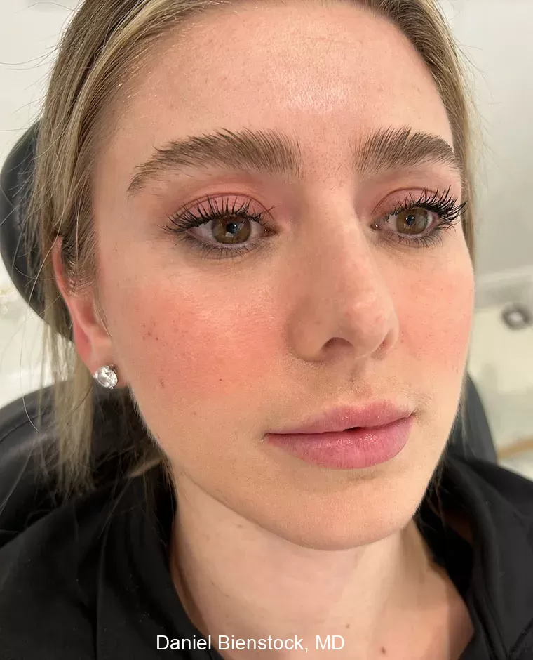 Before Lip Filler - Dr. Daniel Bienstock