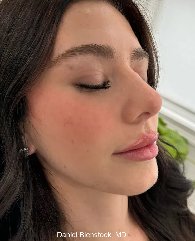 After Lip Filler - Dr. Daniel Bienstock